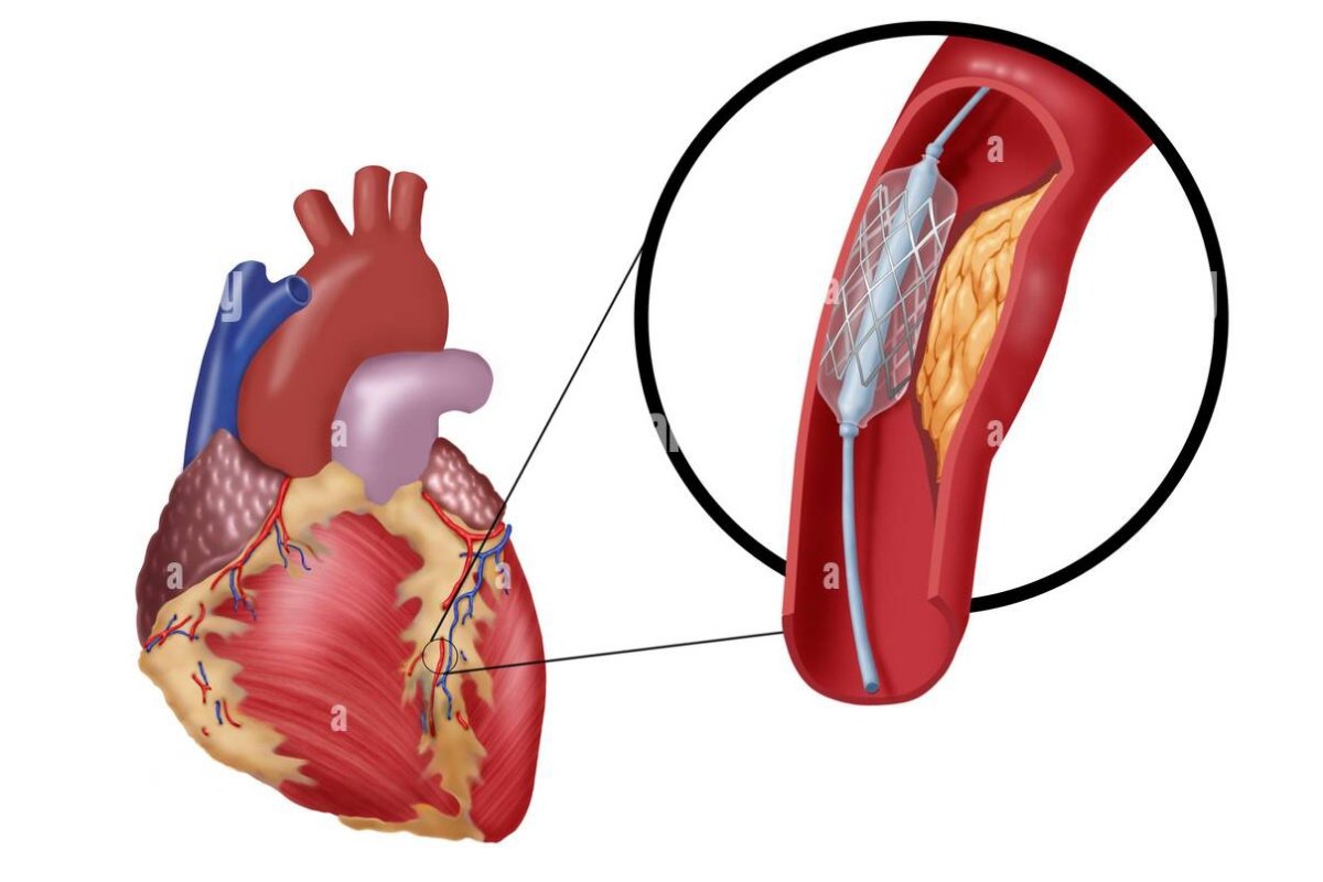 Angioplasty: Type,procedure,Details&Recover.