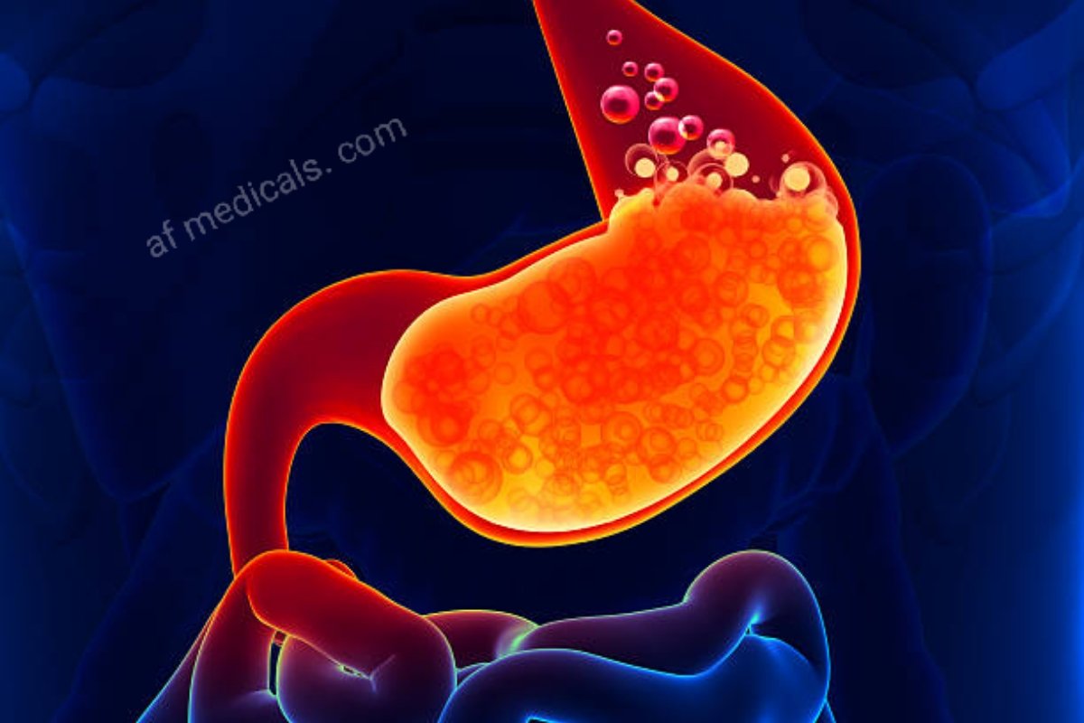 Gastroesophageal Reflux