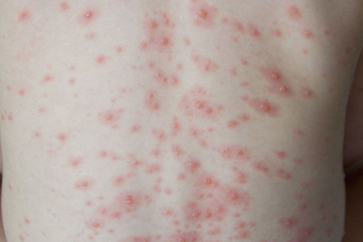 Introduction to chickenpox