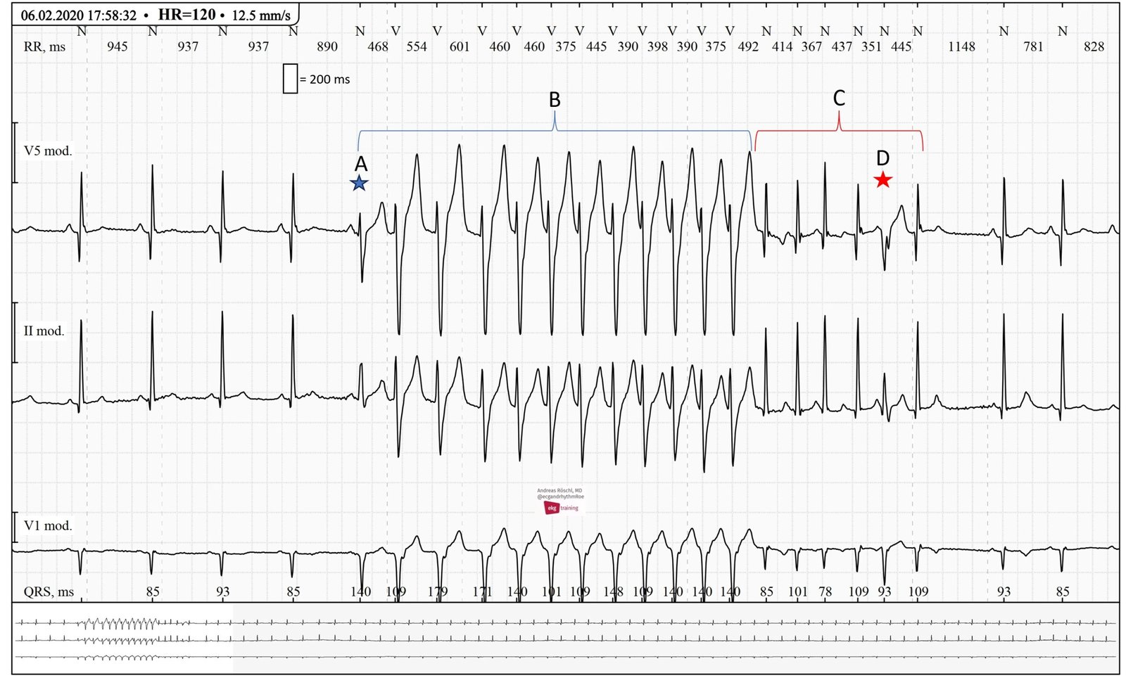 Supra-ventricular Tachycardia