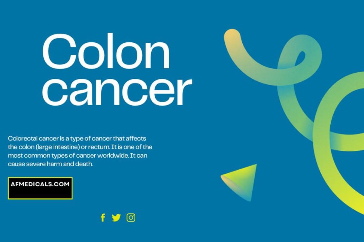 Colon cancer